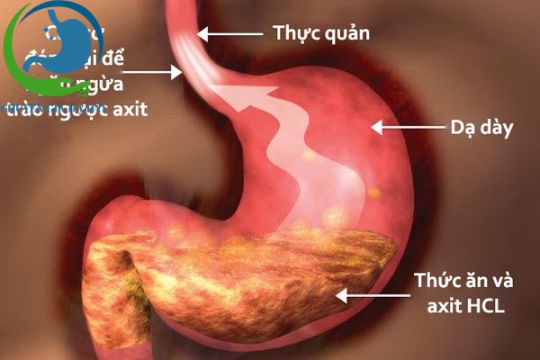Sử dụng Mosapride US cải thiện tình trạng thức ăn lưu trữ trong dạ dày