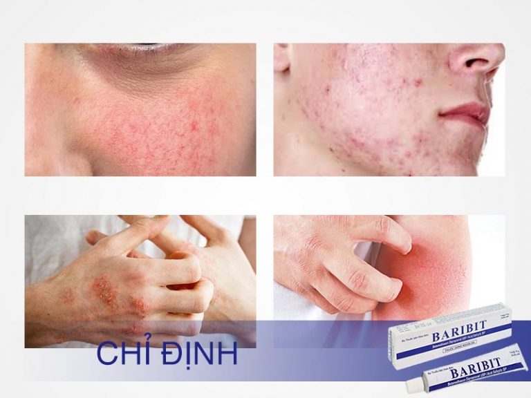 Thuốc mỡ bôi da Baribit 15g: Công dụng, SĐK, mua ở đâu?