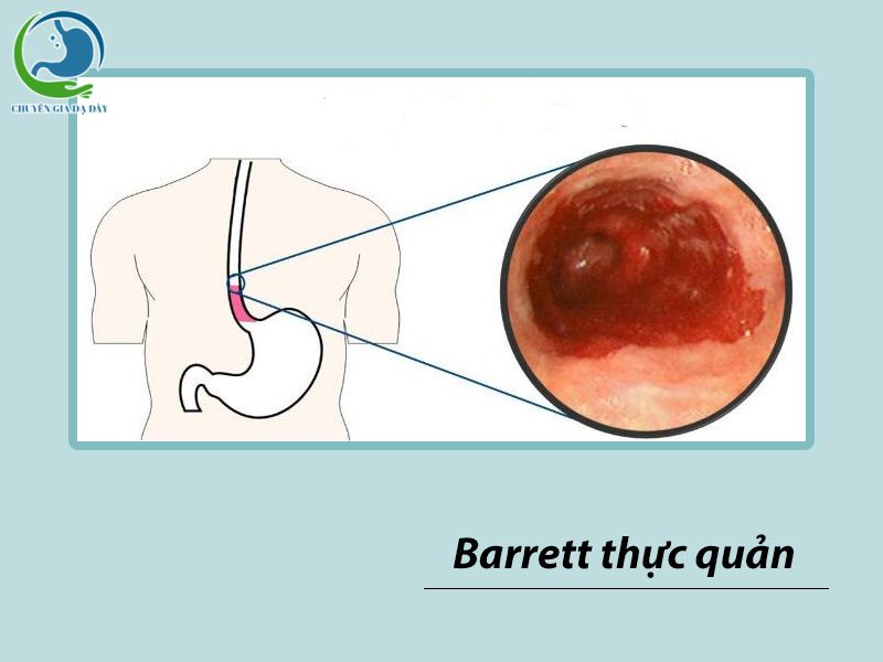 Barrett thực quản là một biến chứng nguy hiểm của trào ngược dạ dày thực quản