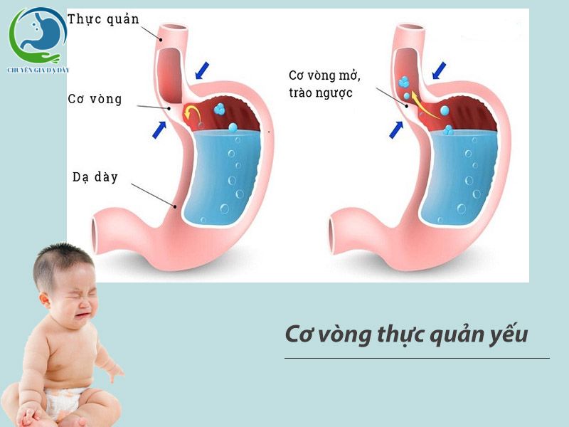 Cơ vòng thực quản yếu là nguyên nhân gây trào ngược dạ dày thực quản cho bé