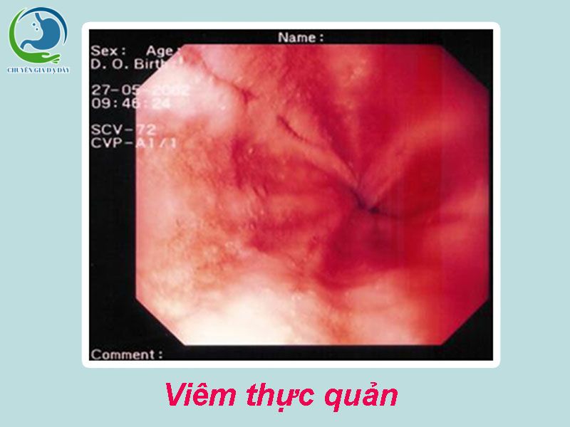 Hình ảnh nội soi viêm thực quản